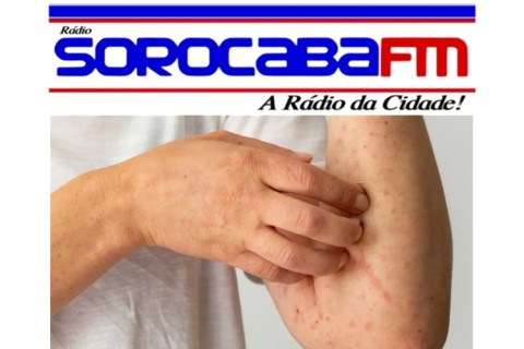 São Paulo confirma 16 casos de sarampo e amplia vacinação após identificação de cadeia de transmissão do vírus